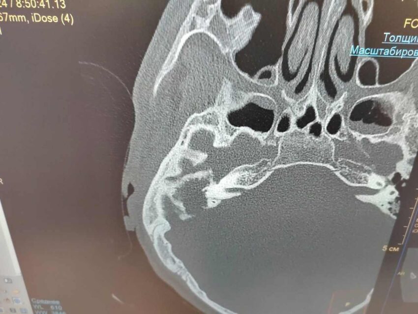 В Воронеже медики прооперировали 17-летнего пациента с крайне сложным отитом