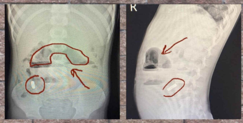 Из кишечника 6-летнего мальчика удалили 10 магнитов воронежские врачи